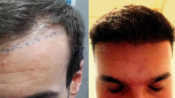 First Choice Hair Transplant & Cosmetics Model Town Jalandhar