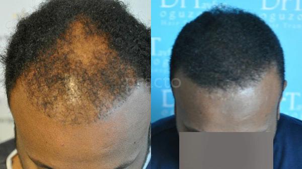First Choice Hair Transplant & Cosmetics Model Town Jalandhar