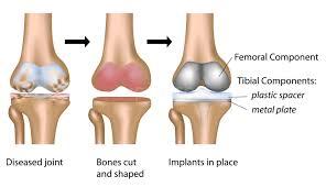 Dr.Mukesh:Nahar Orthopedic Centre Satna Semaria Chowk Satna
